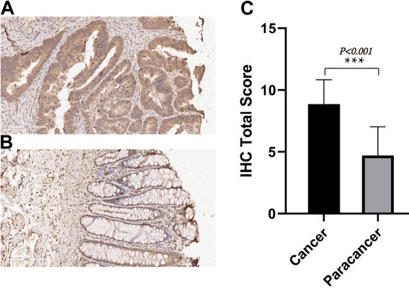 TIMP1 expression in CRC tissues.jpg